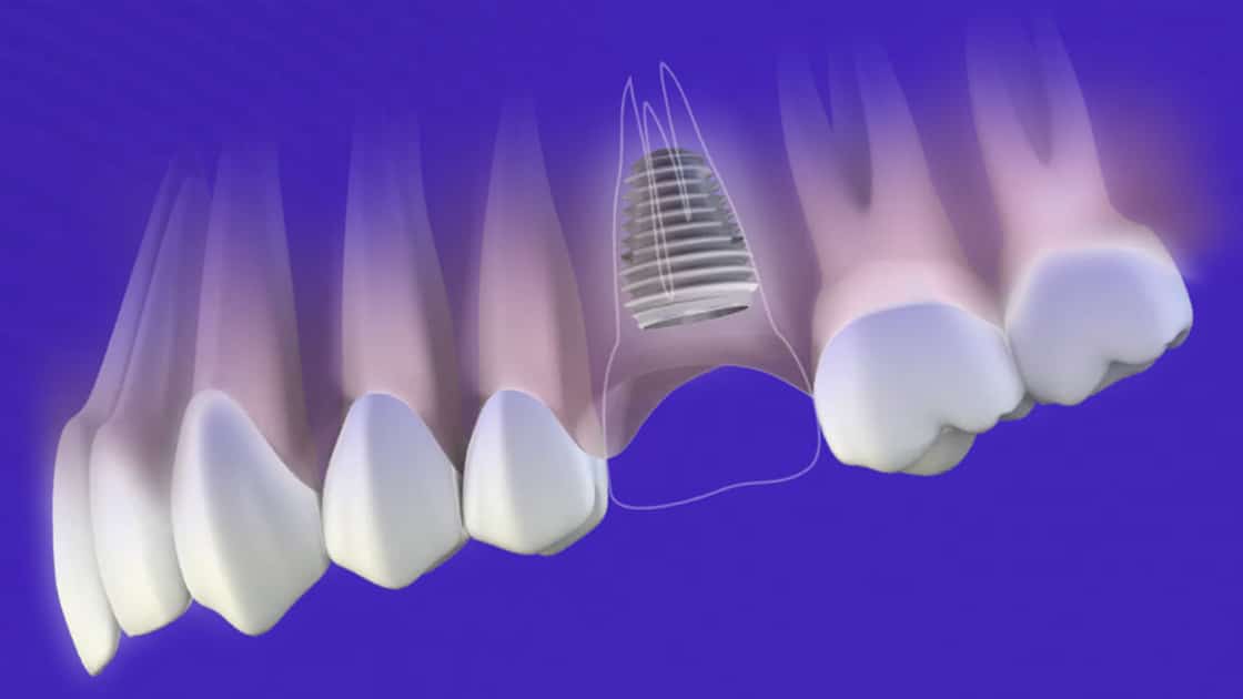 Molar Replacement Therapy