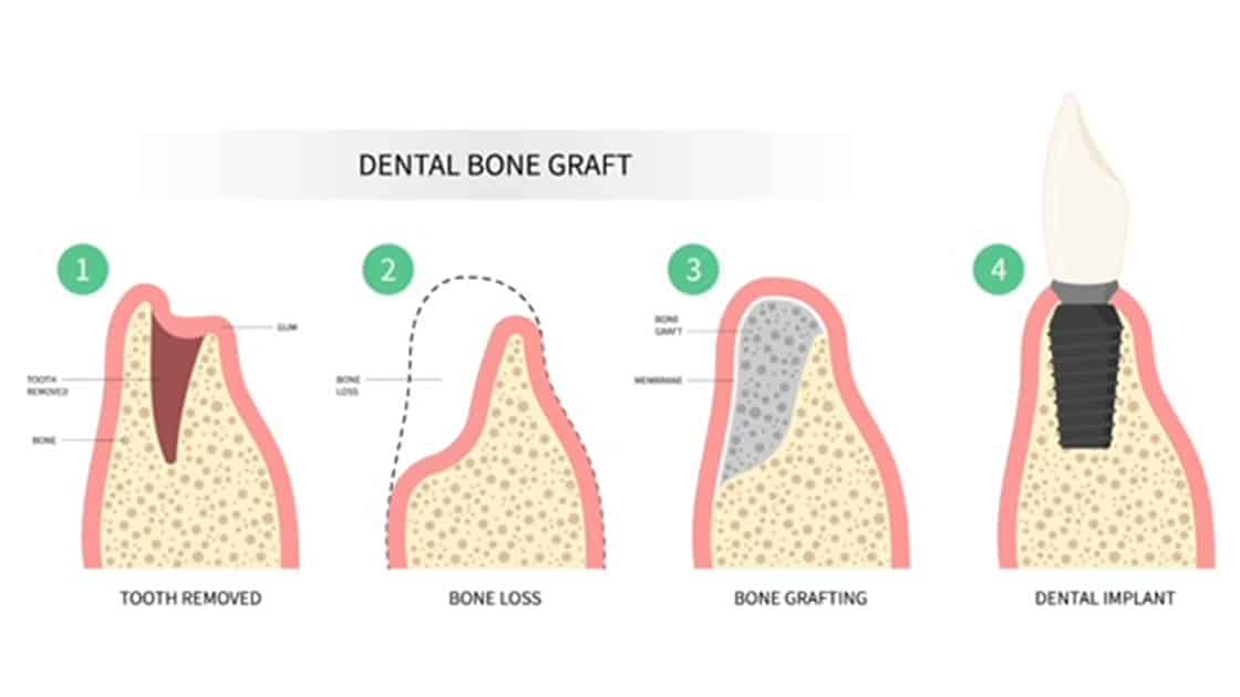 Bone Grafting