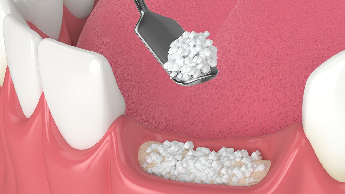 bone grafting