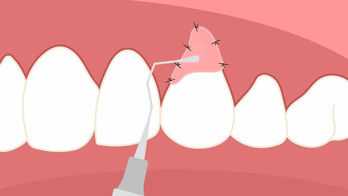 connective tissue grafting