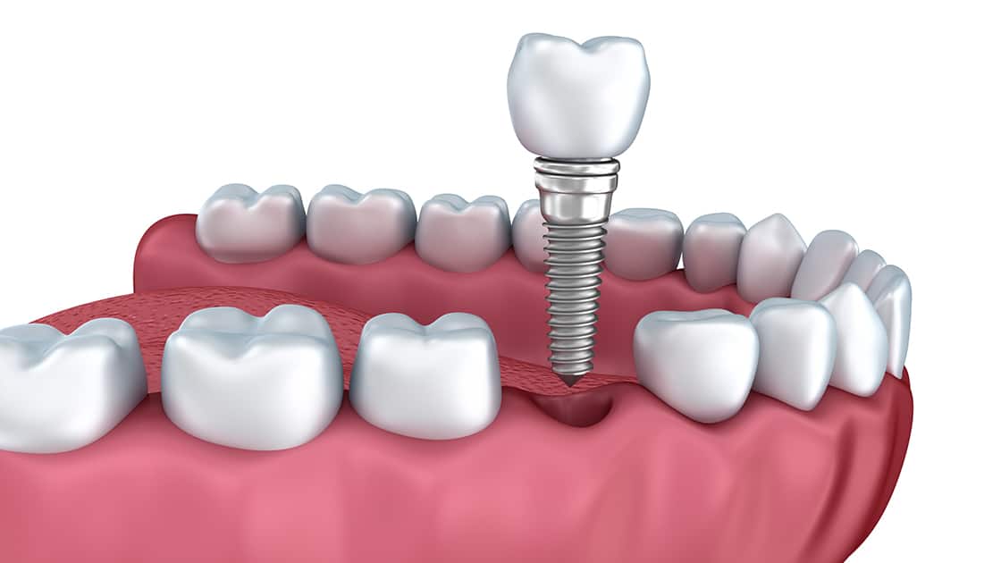 Single Dental Implant Photo