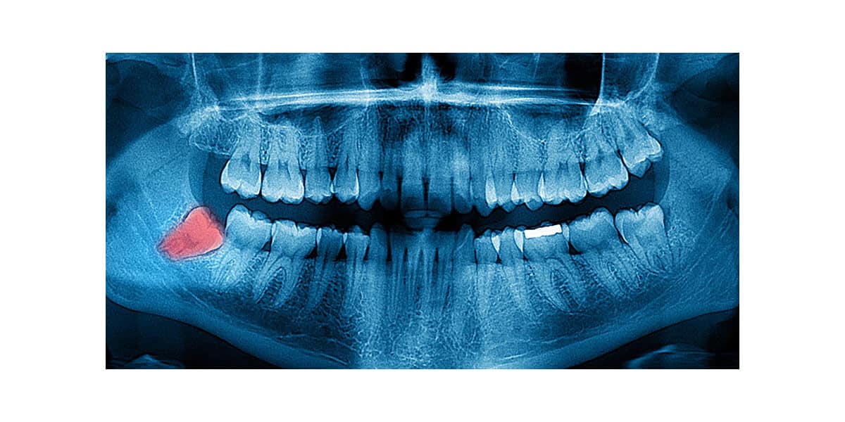 Wisdom Teeth