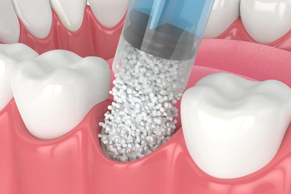 How Long Does It Take to Recover from a Dental Bone Graft?