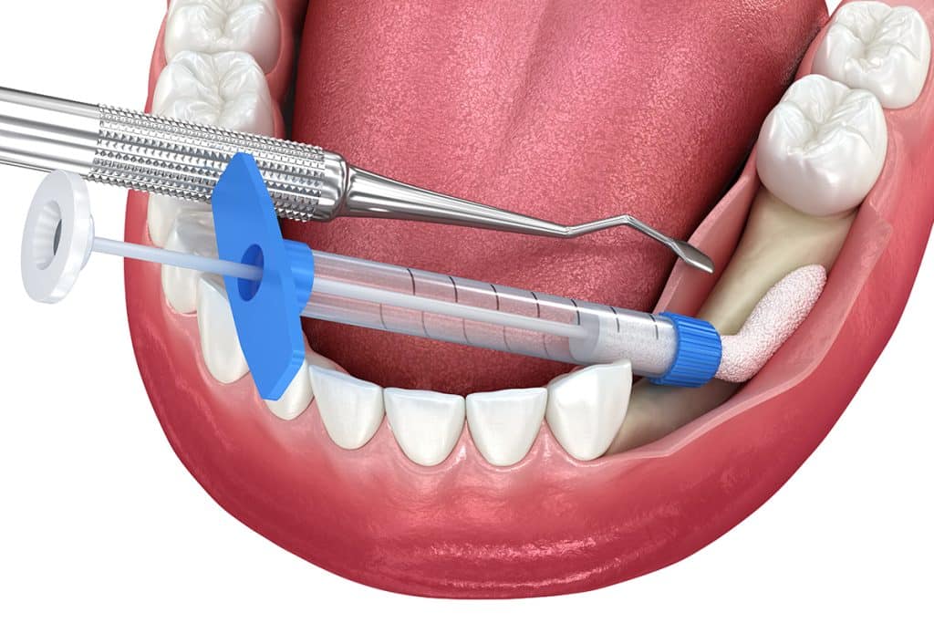 What Are the Different Types of Dental Bone Grafts?